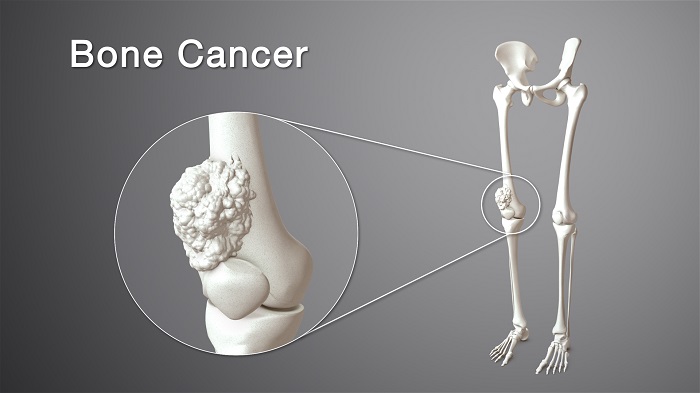 Ung thư xương là sự phát triển mất kiểm soát một cách ác tính của các tế bào xương